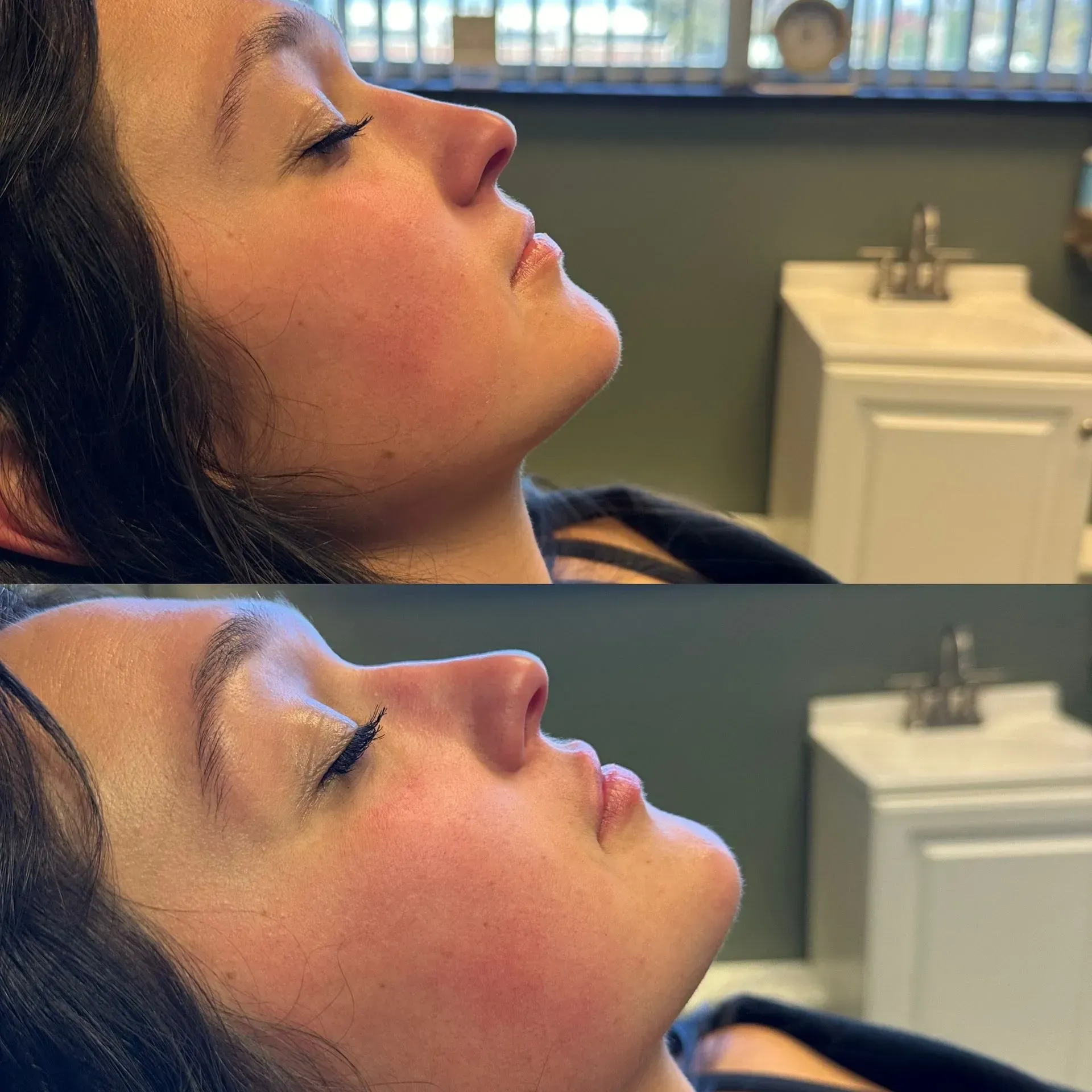 Comparison of woman's profile before and after cosmetic procedure; showing nose and lip changes.