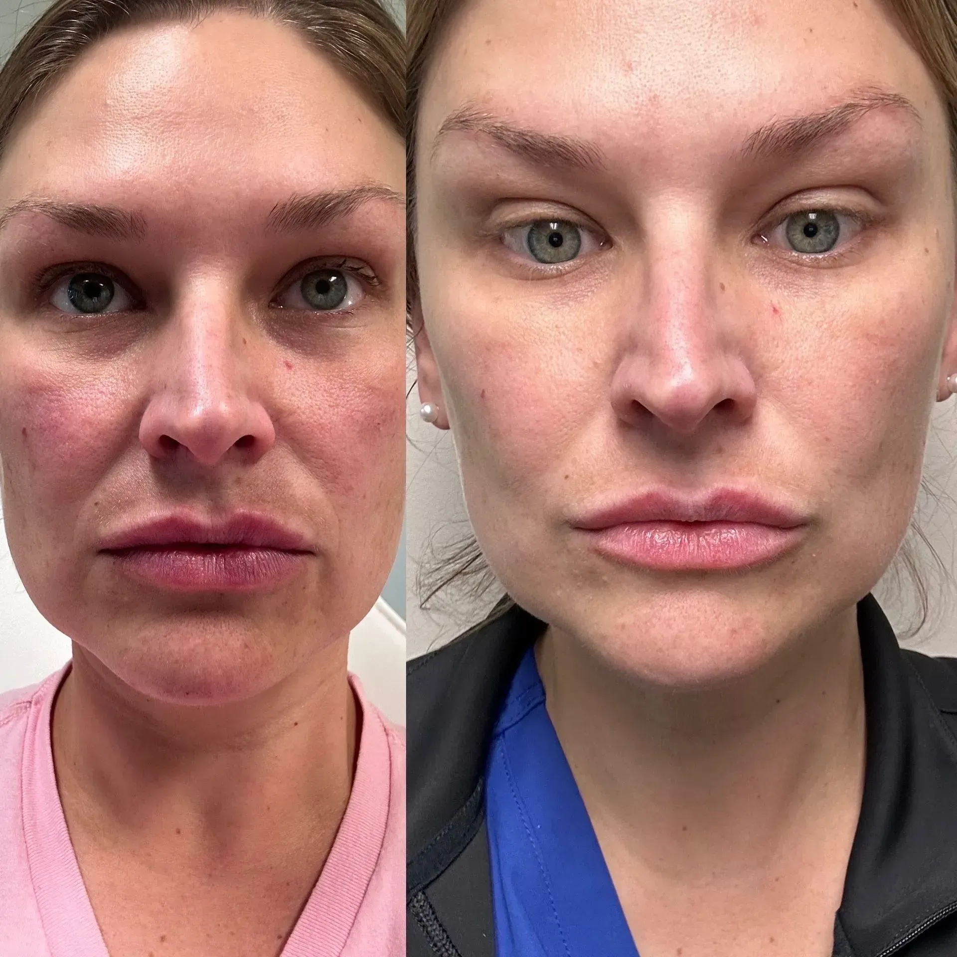 Before-and-after facial comparison: woman with redness and swelling before, smoother skin and enhanced features after.