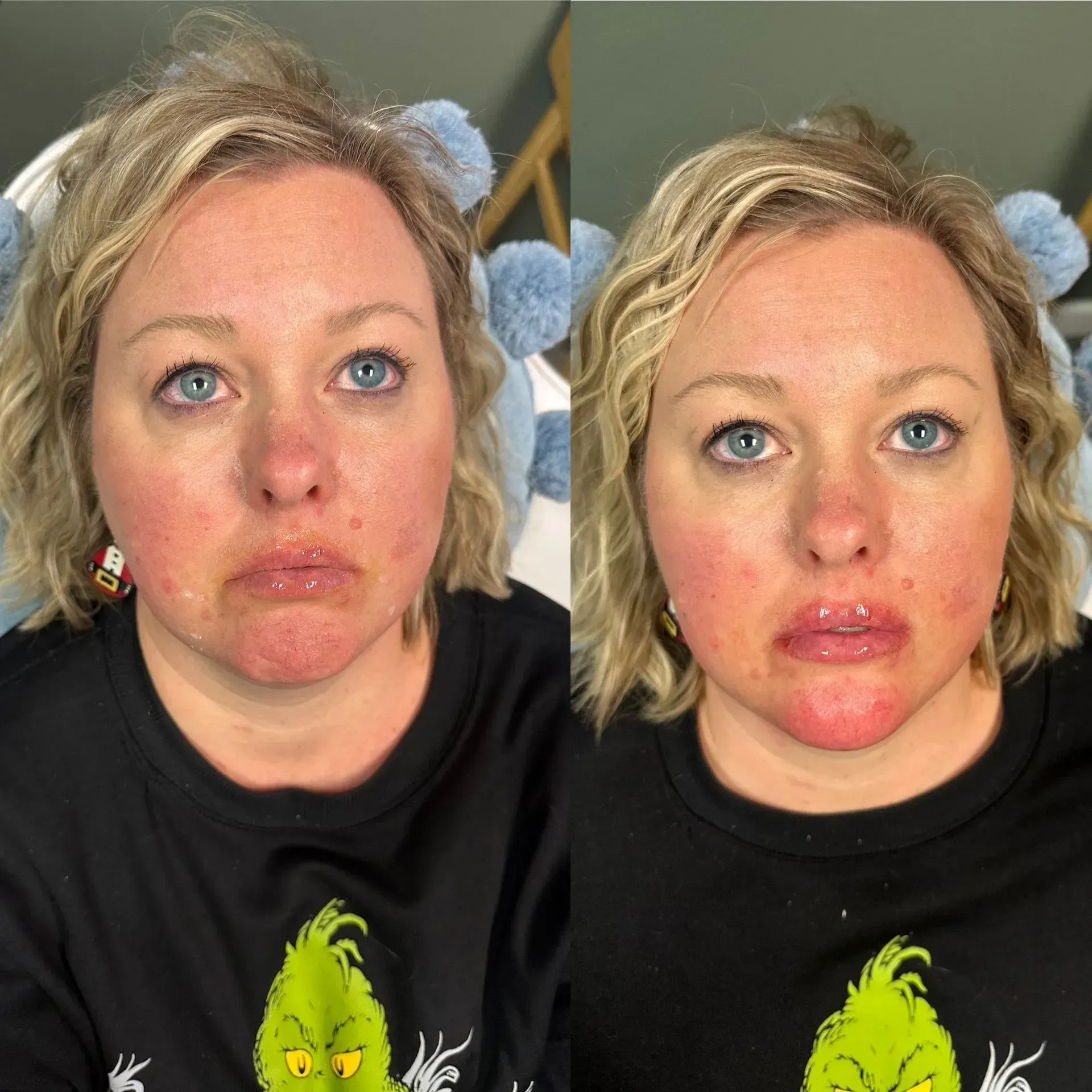 Before and after photos of a woman, showing visible changes after a cosmetic procedure on her lips.