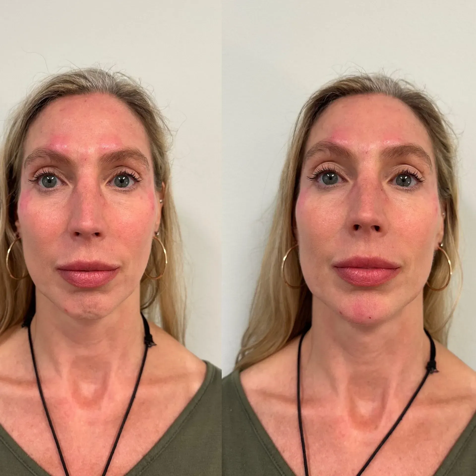 Before and after photos of a woman's face after cosmetic procedures. Lips are fuller in the after photo.