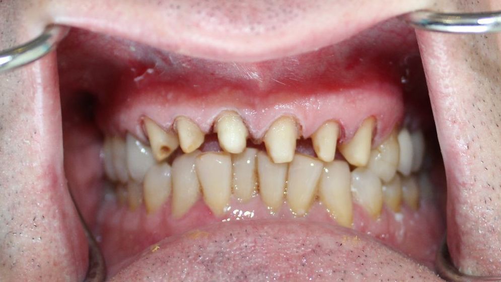Mouth open, showing severely worn teeth with gum recession, held open with dental tools.