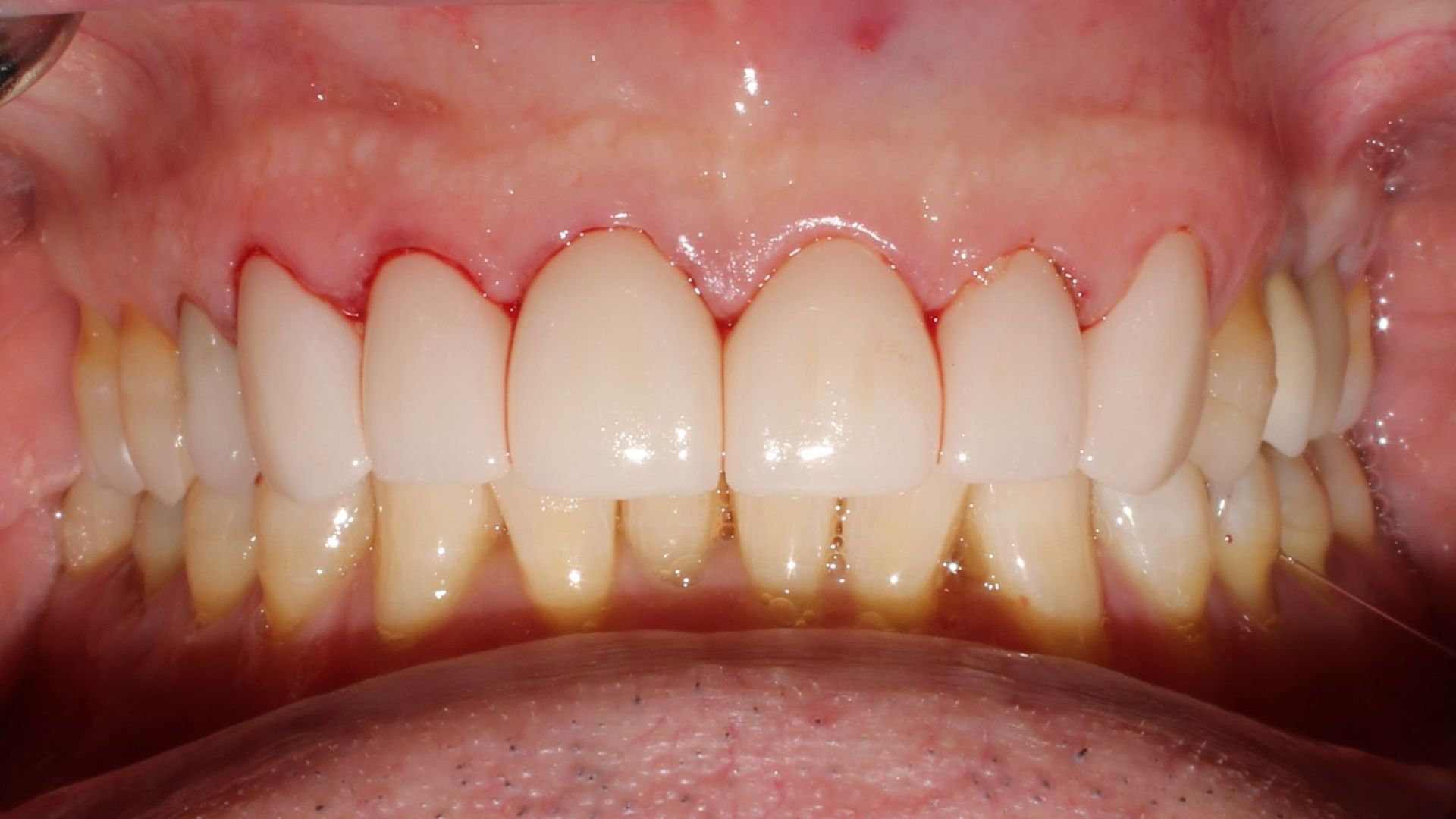 Close-up of teeth. Front teeth are white, with red gums visible. Yellowish teeth in the background.