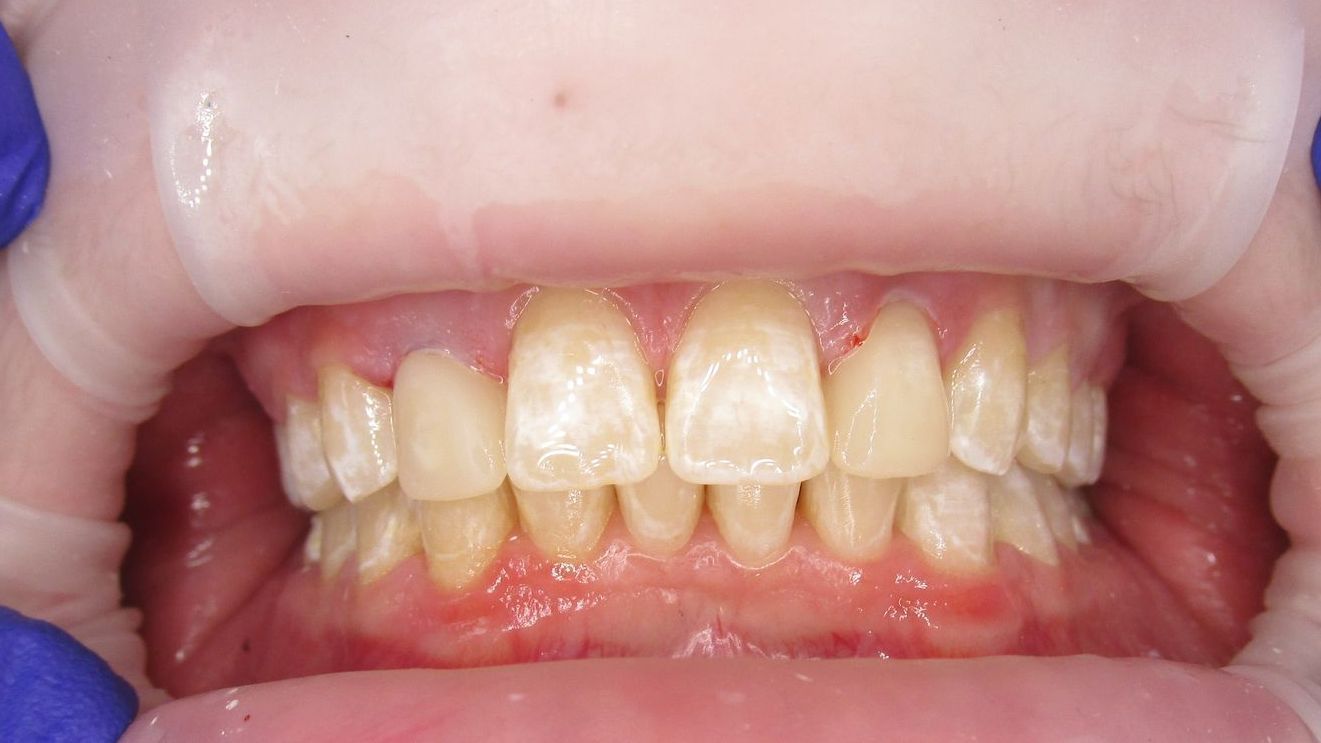 Close-up view of teeth in a mouth, held open with a retractor, showing yellowed teeth and red gums.