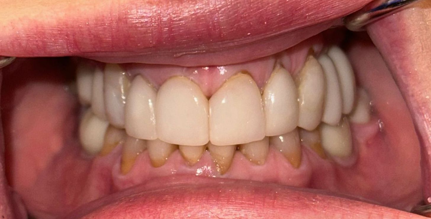 Close-up of a person's mouth showing teeth; upper teeth are white and lower teeth are stained.