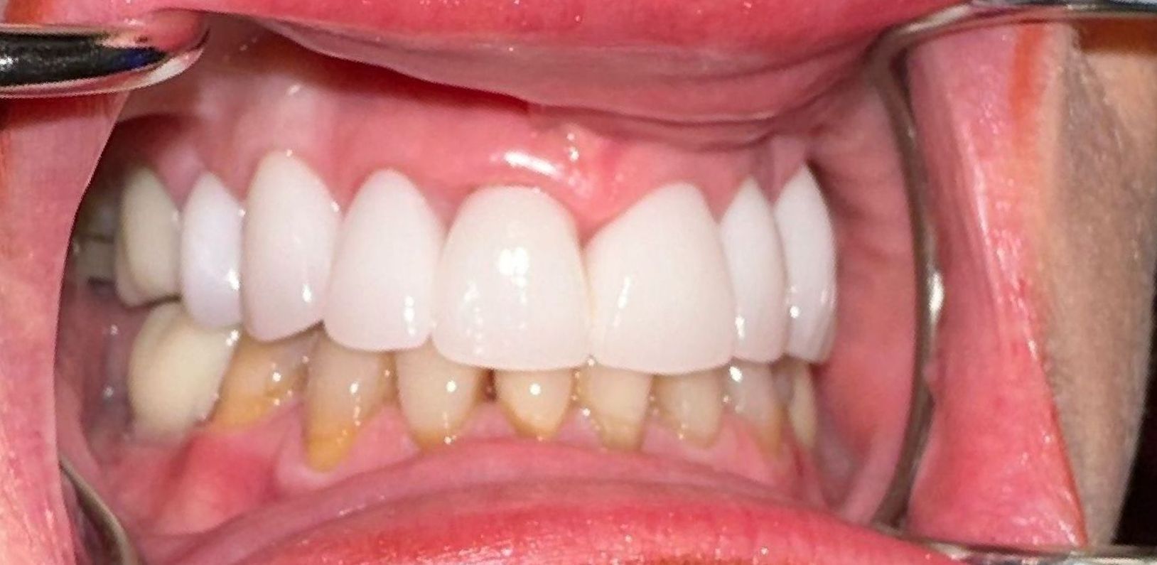 Dental exam of upper teeth, showing bright, white crowns and natural lower teeth, against red gums.