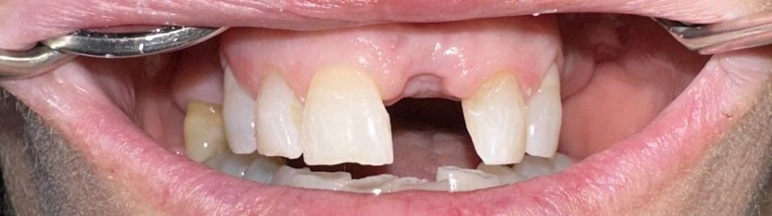 Close-up of a mouth with a missing tooth and metal dental instrument in view.