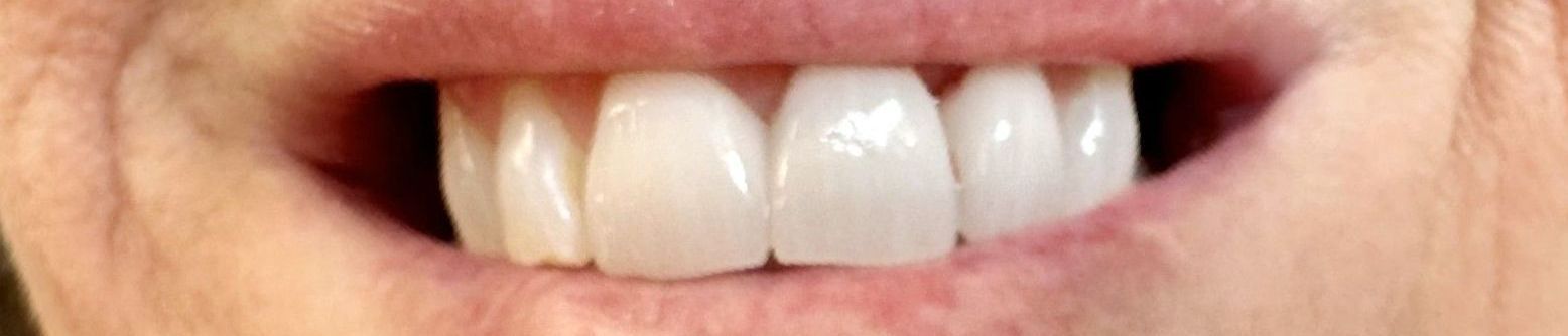 Close-up of a person's smiling mouth showing straight, white teeth.