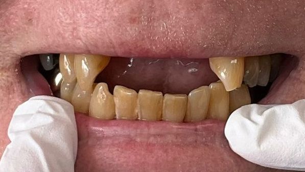 Close-up of a person's mouth, showing worn and yellowed teeth with some missing. Gloved hands frame the mouth.