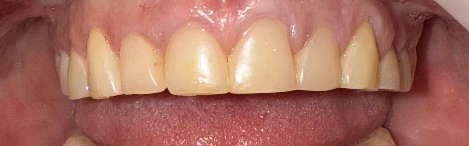 Close-up view of a person's upper teeth. The teeth are yellow and visible with the tongue below.