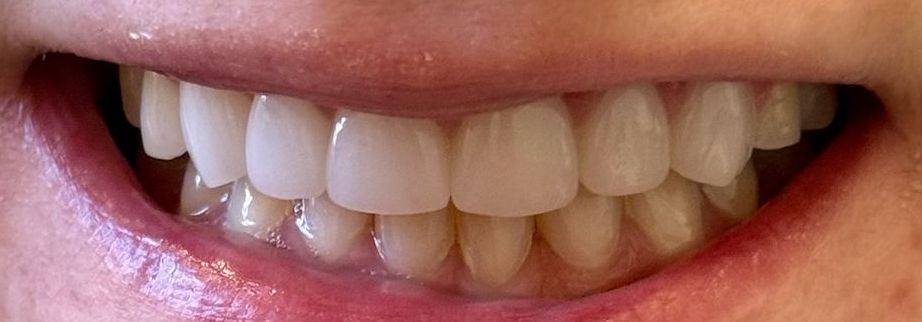 Close-up of a smiling mouth with bright white teeth, pink lips.