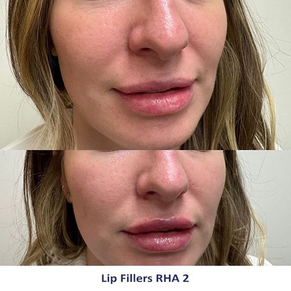 Lip Fillers RHA 2