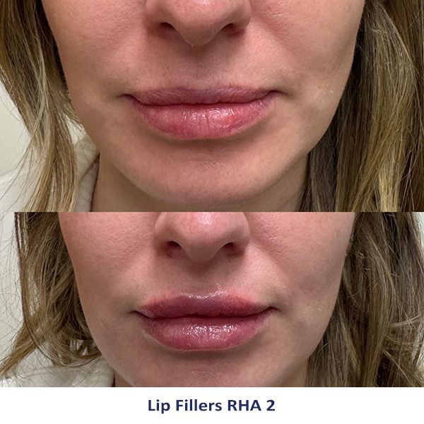 Lip Fillers RHA 2