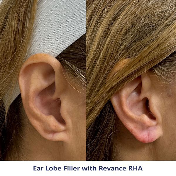 Ear Lobe Filler with Revance RHA