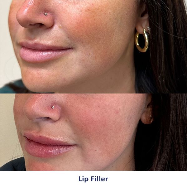 Lip Fillers