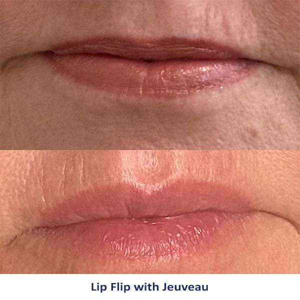 Lip Flip with Jeuveau