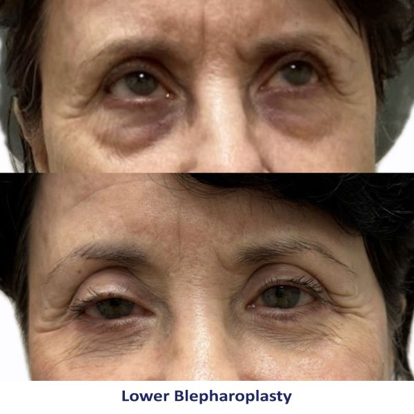 Lower Blepharoplasty