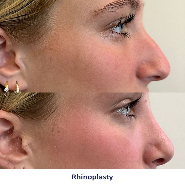 Rhinoplasty