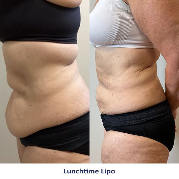 Two pictures of a woman 's stomach before and after lunchtime lipo