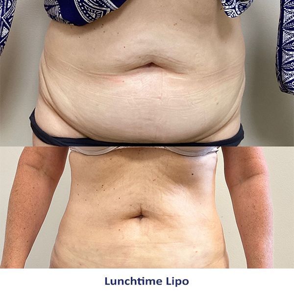 A woman's stomach before and after lunchtime lipo
