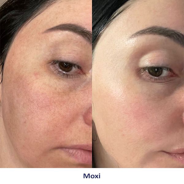 A before and after photo of a woman's face.