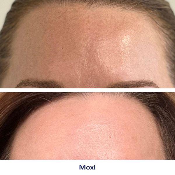 A before and after picture of a woman's forehead.