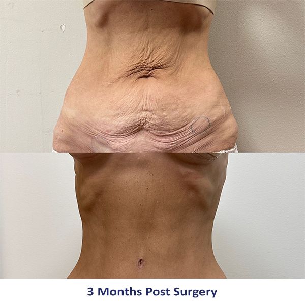 A woman's stomach is shown before and after surgery.