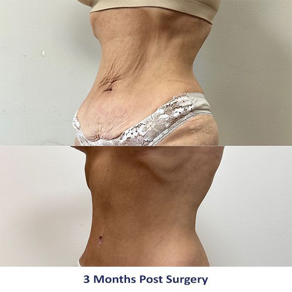 A woman's stomach is shown before and after surgery