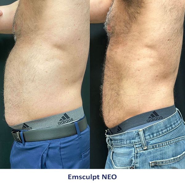 A before and after picture of a man's stomach with adidas underwear.