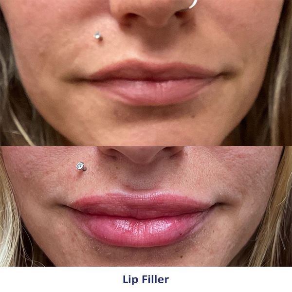 A before and after picture of a woman's lips with lip filler