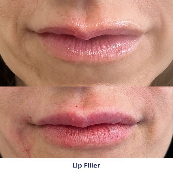 A before and after photo of a woman's lips with lip filler.
