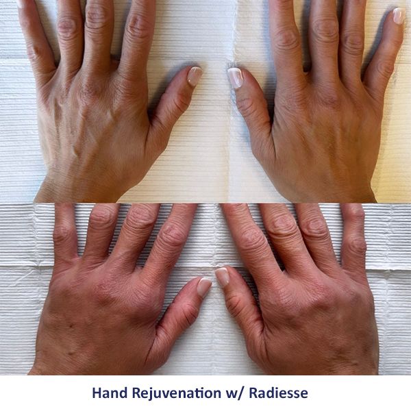 A before and after photo of a person's hands with the caption hand rejuvenation w / radiesse