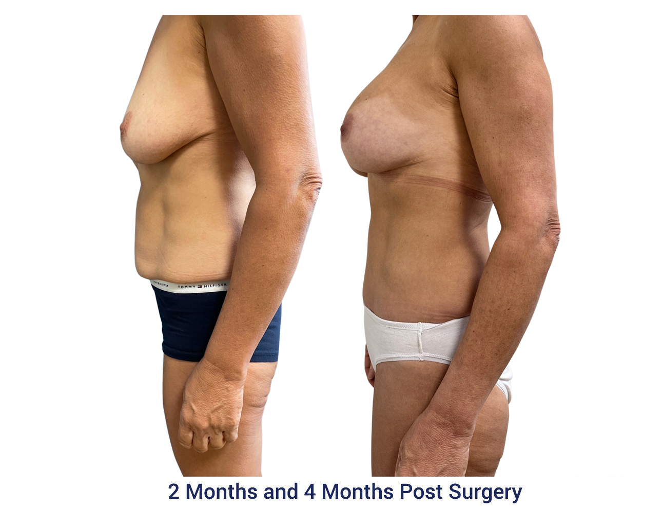 Before and after photo of an Abdominoplasty