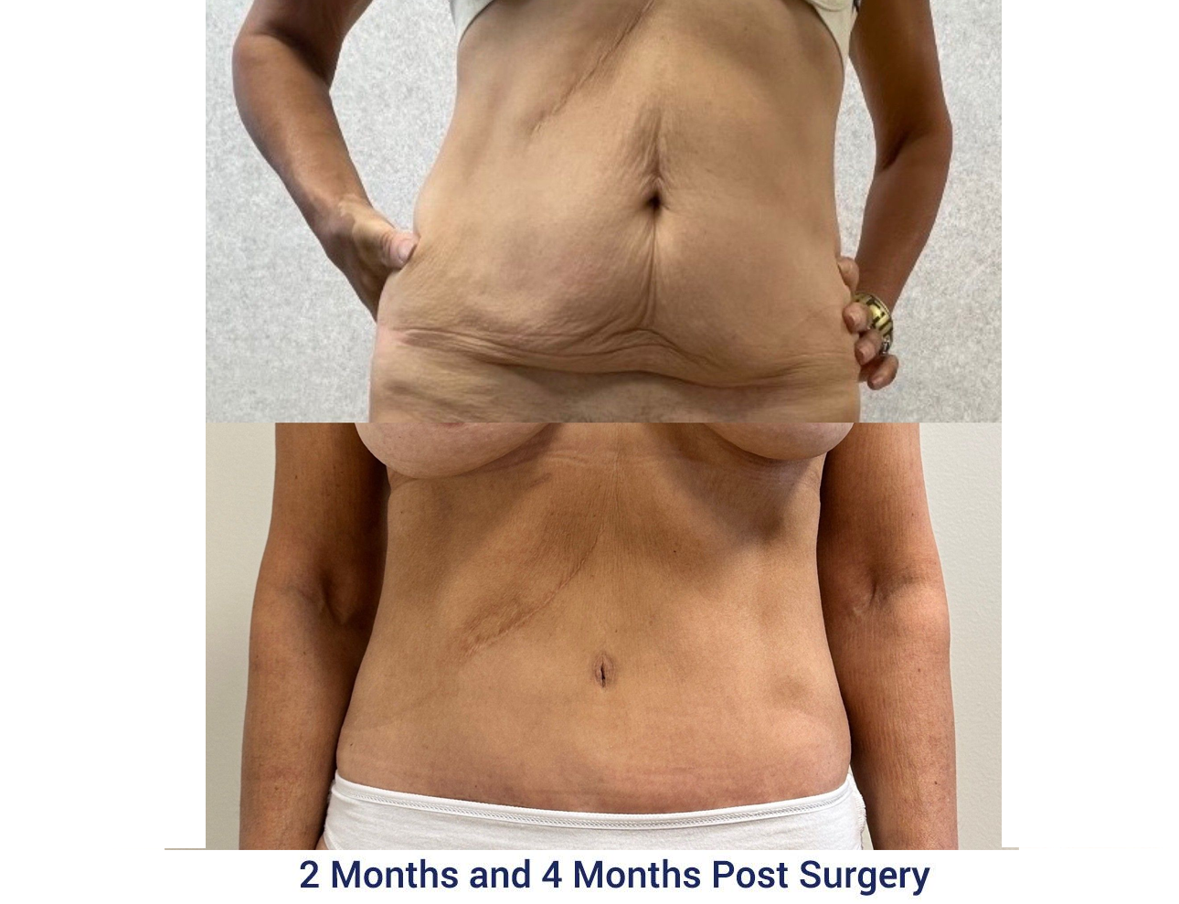 A woman 's stomach is shown before and after surgery.