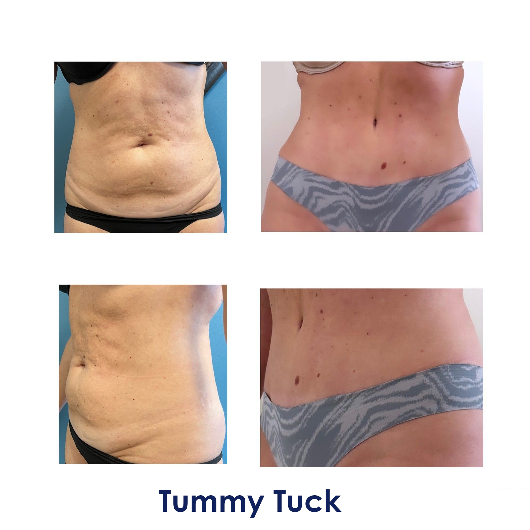 A woman's stomach before and after tummy tuck surgery.