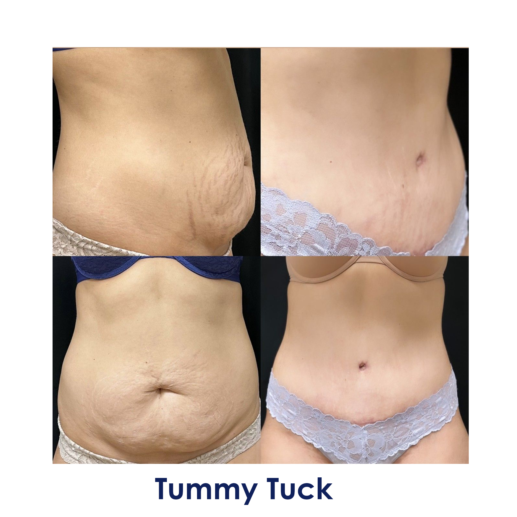 A woman's stomach before and after tummy tuck surgery.