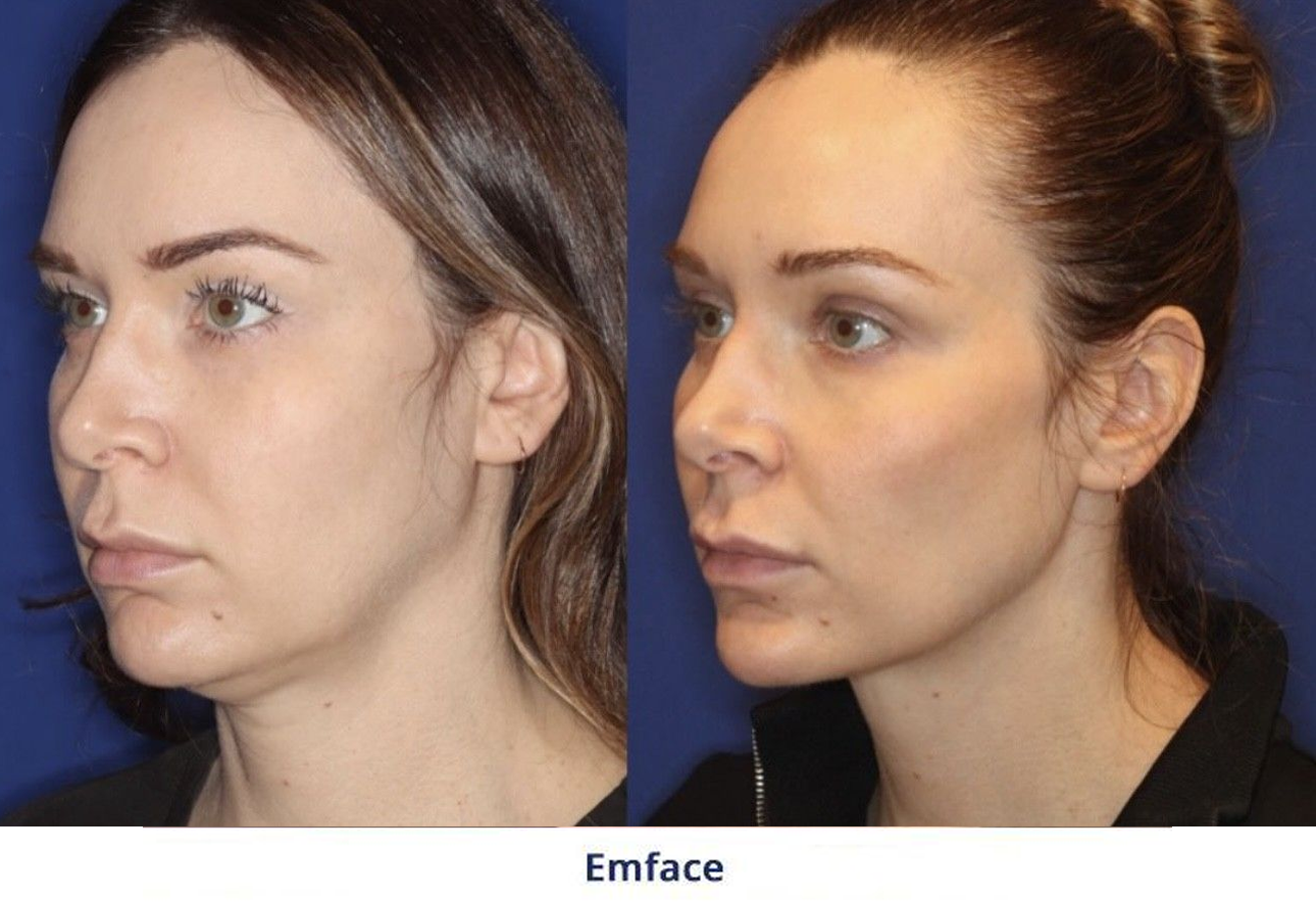 A before and after picture of a woman's face and neck.