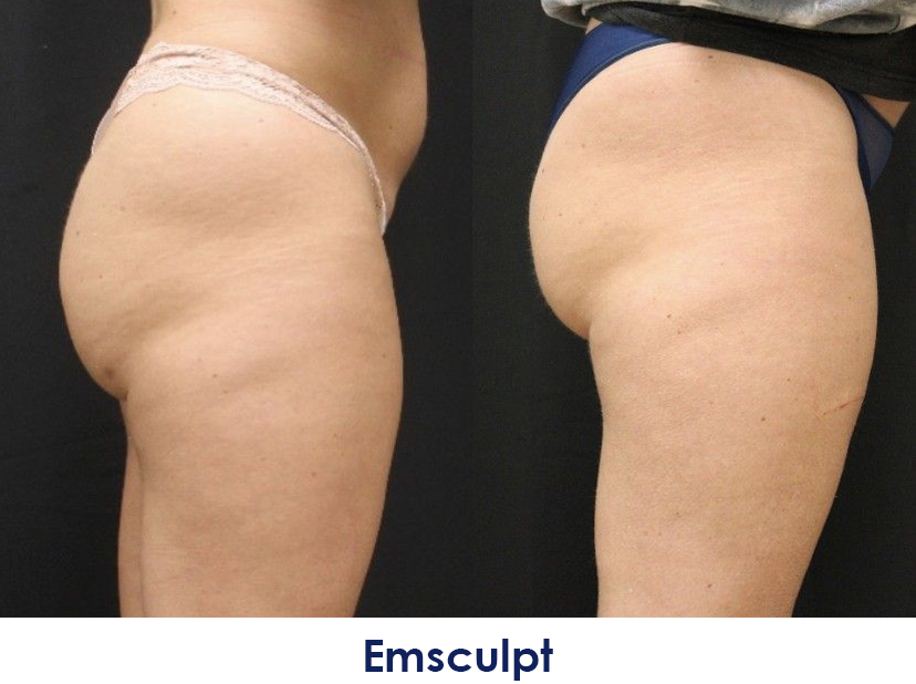 Emsculpt before and after