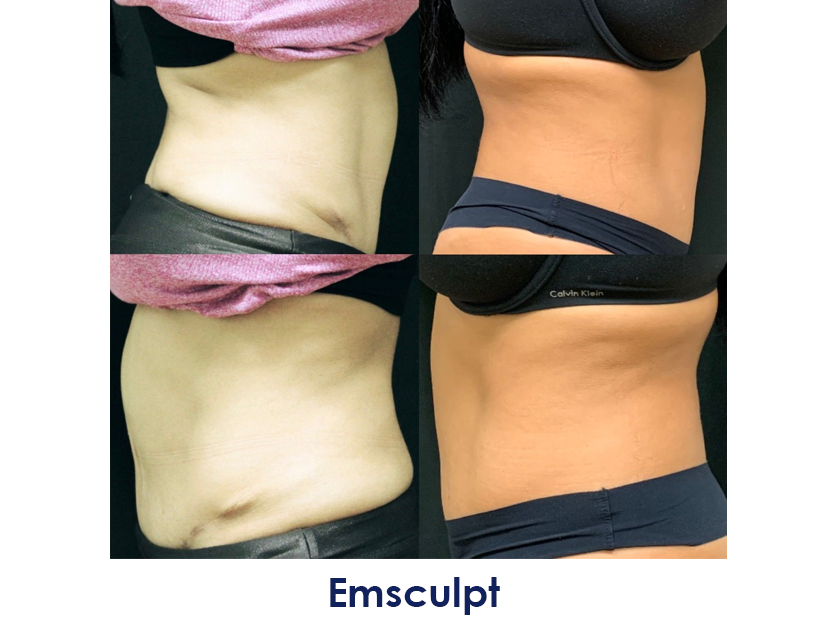 A before and after photo of a woman's stomach.