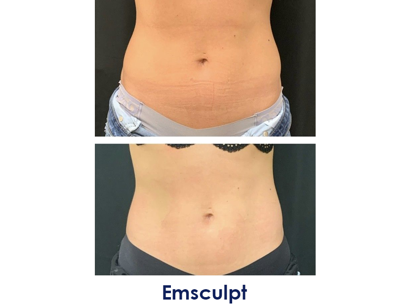 A before and after photo of a woman's stomach.