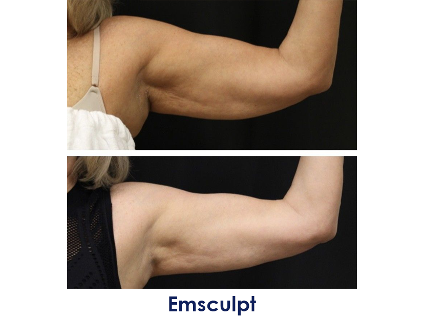 A before and after photo of a woman's arms.