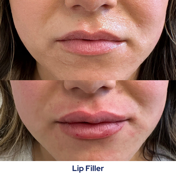 A before and after photo of a woman's lips.
