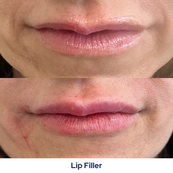 A before and after picture of a woman's lips.