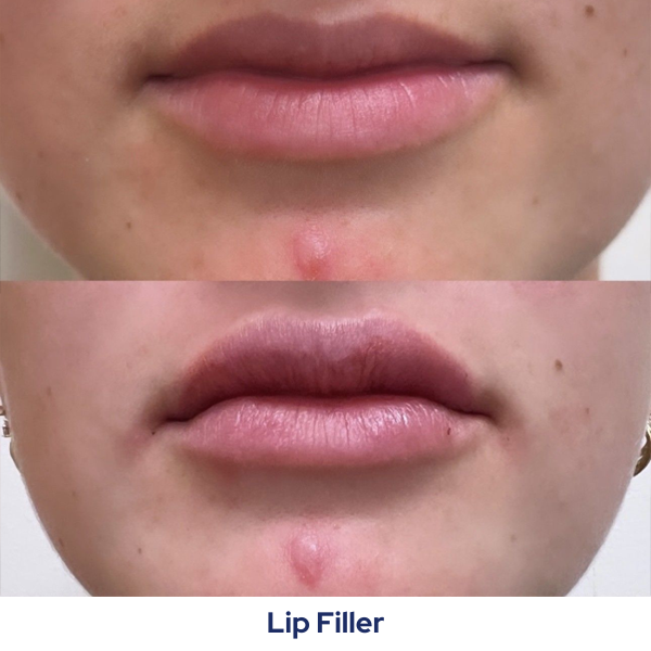 A before and after picture of a woman's lips with a lip filler.