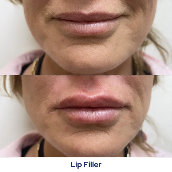 A before and after photo of a woman's lips with the caption lip filler.