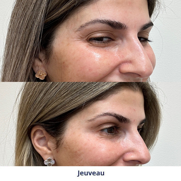 A before and after image of a woman's face