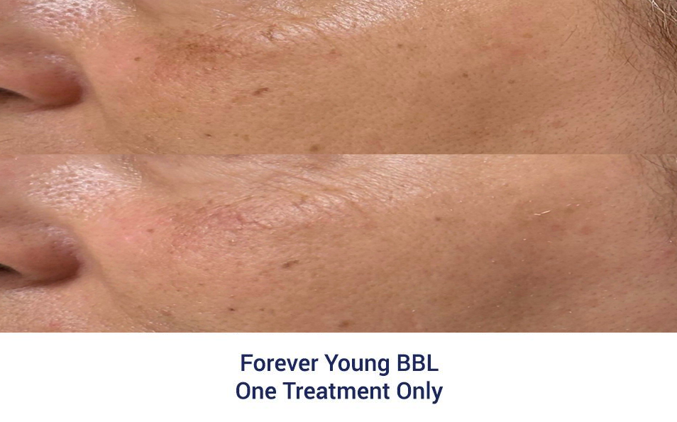 A close up of a woman 's face before and after a treatment.