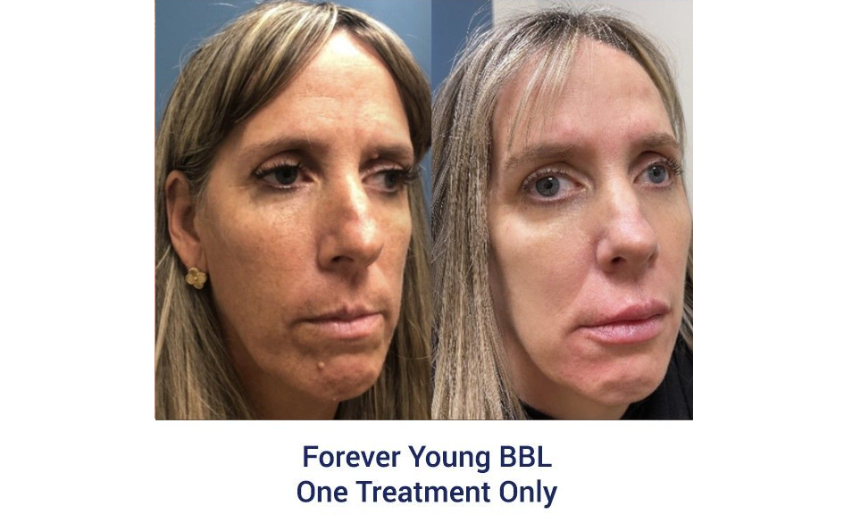 A before and after photo of a woman's face.