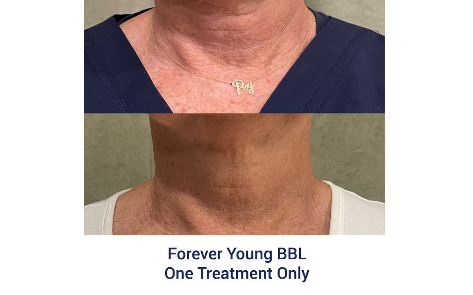 A neck is shown before and after a treatment.