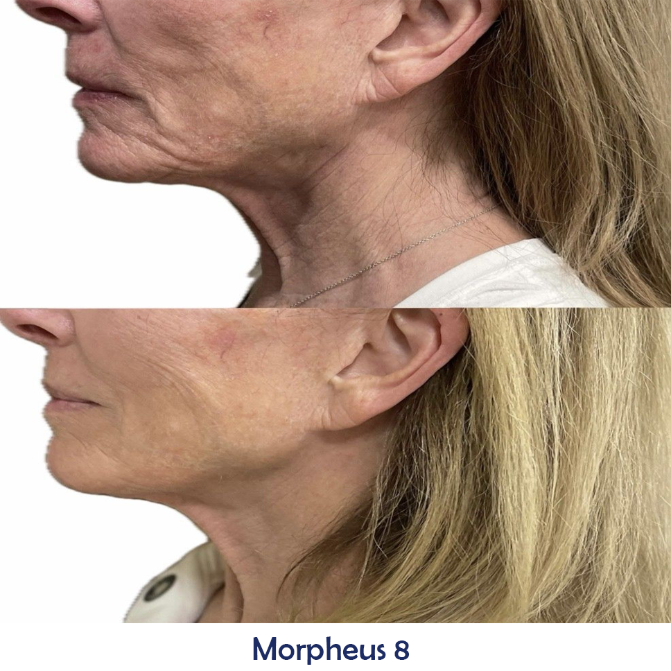 A before and after image of a woman's face and neck
