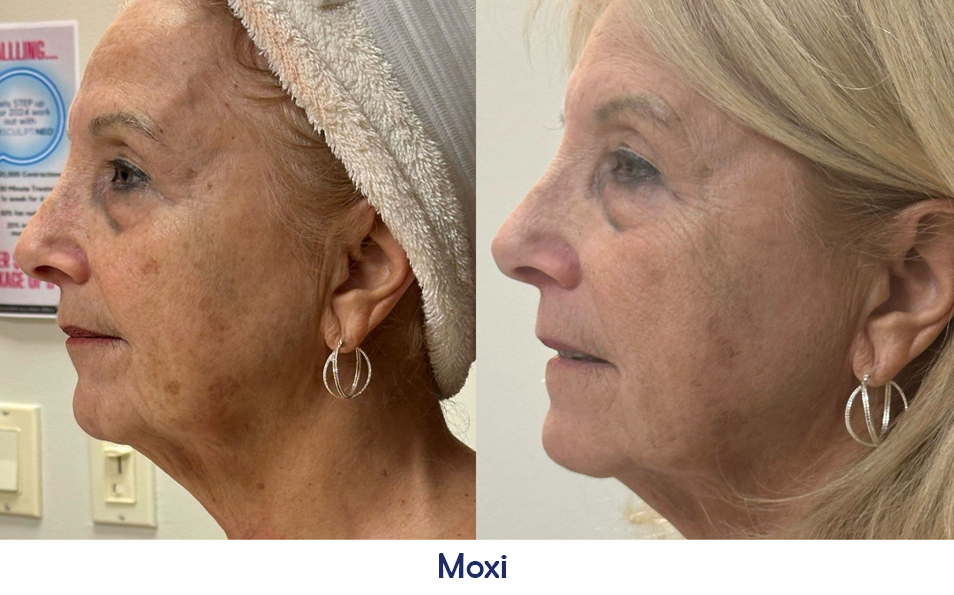 A before and after photo of a woman's face with a towel on her head.